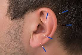 man's ear with auricular needles in it - he will feel the benefits of auricular acupuncture
