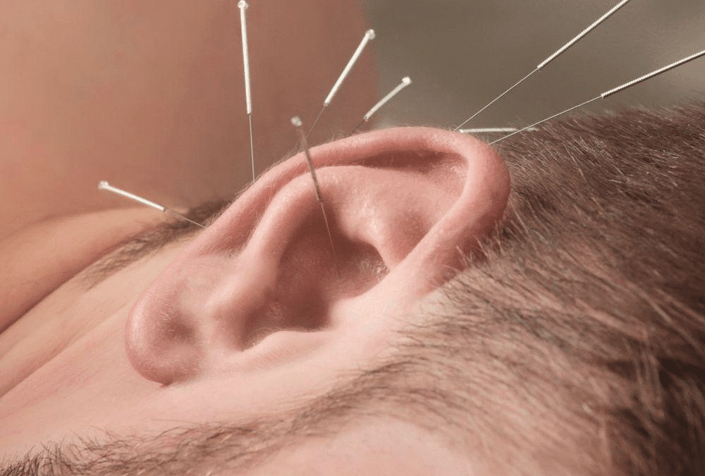 Auricular Acupuncture: This Amazing Treatment Can Ease Pain