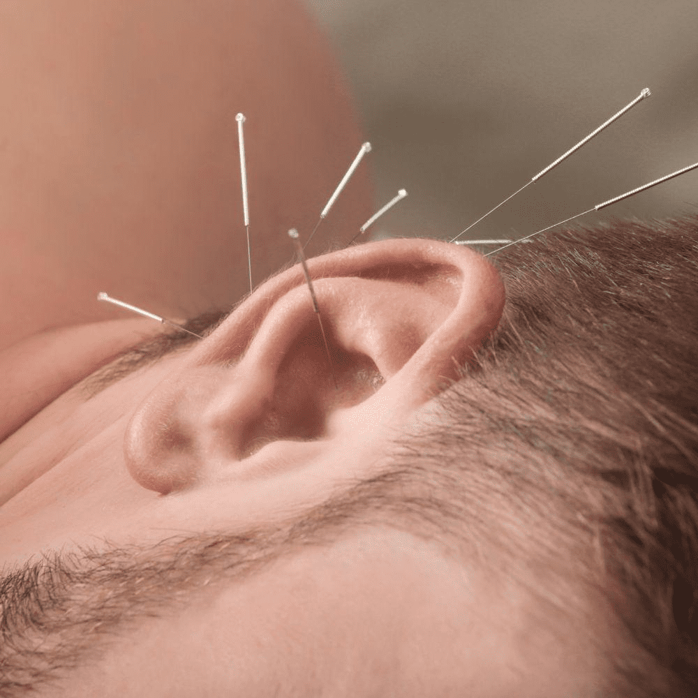 Auricular acupuncture being applied on a man's ear